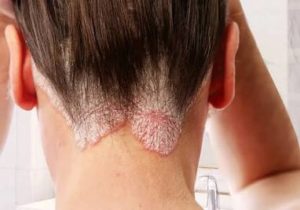 psoriasis on the scalp